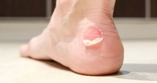 The Common Foot Problems Linked to Poor Shoe Fit