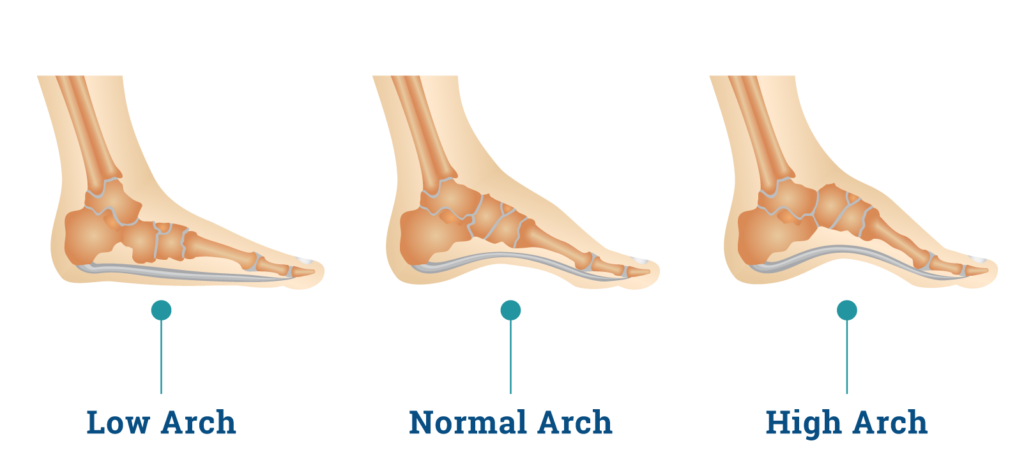 The Different Types of Foot Arches and What They Mean